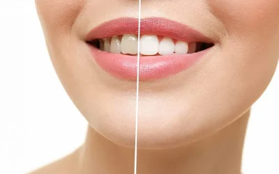 Home Teeth Whitening Kits vs Professional Teeth Whitening