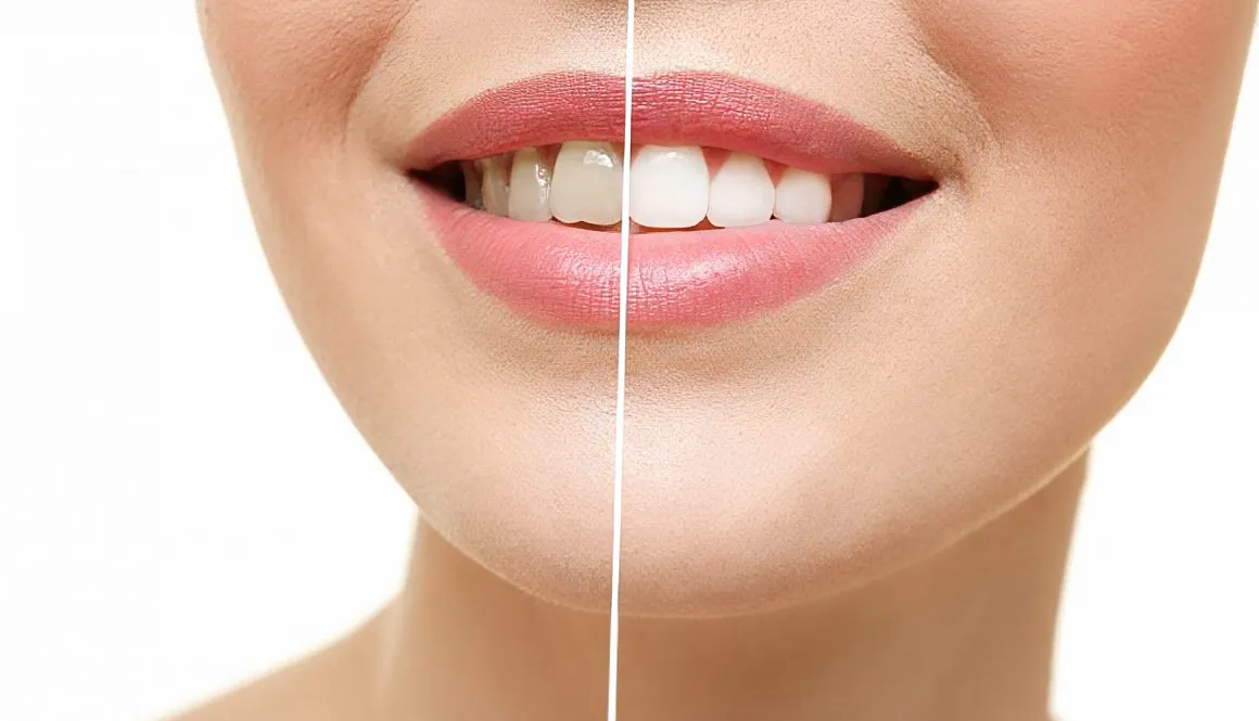 Teeth Whitening