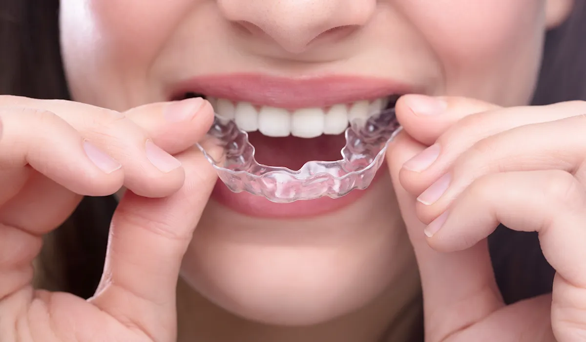 clear aligner clear aligner