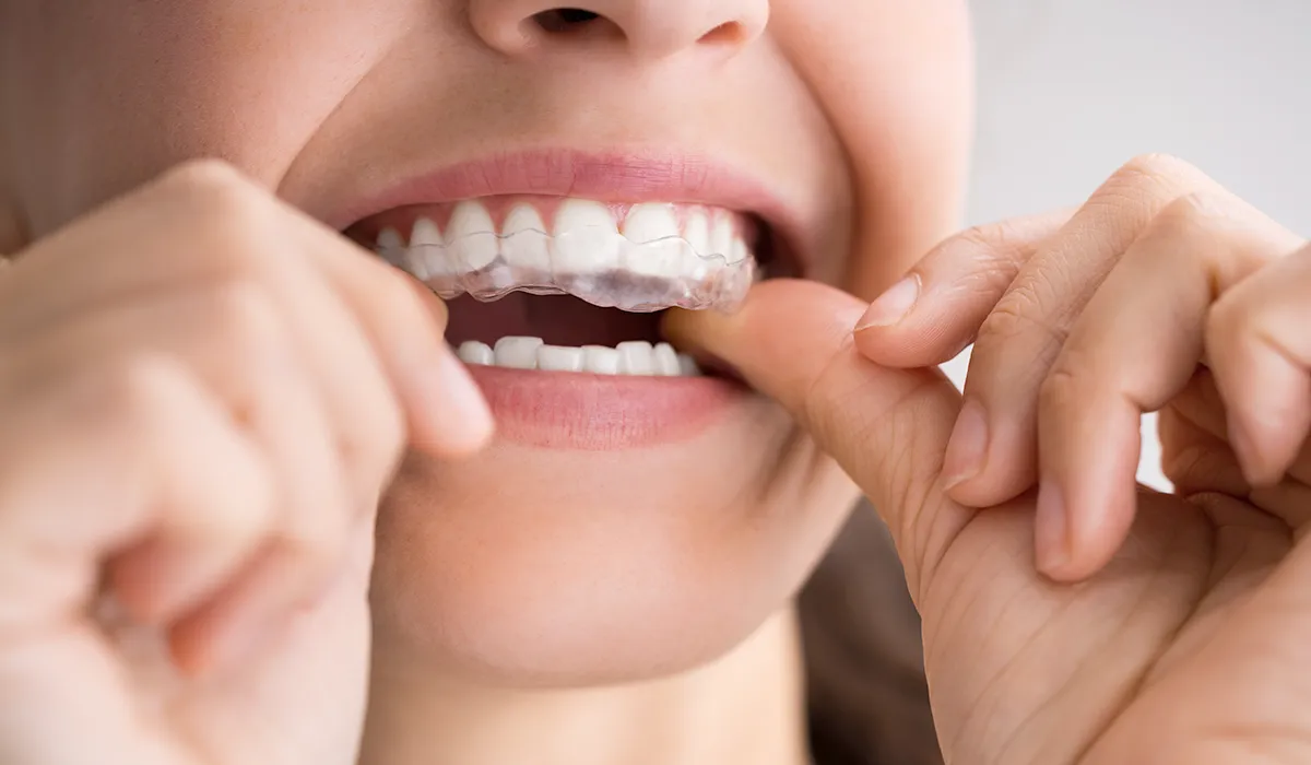 clear aligner