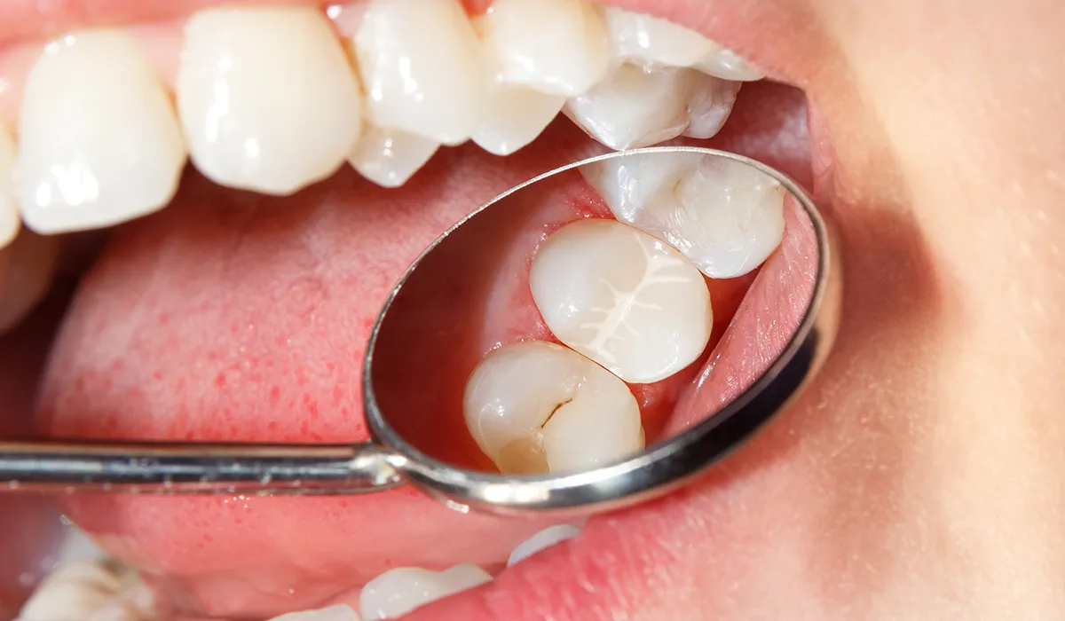 fissure sealants fissure sealants<br />