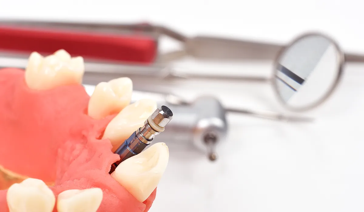 dental implant dental implant