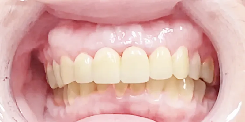 Trial fitting and adjustment