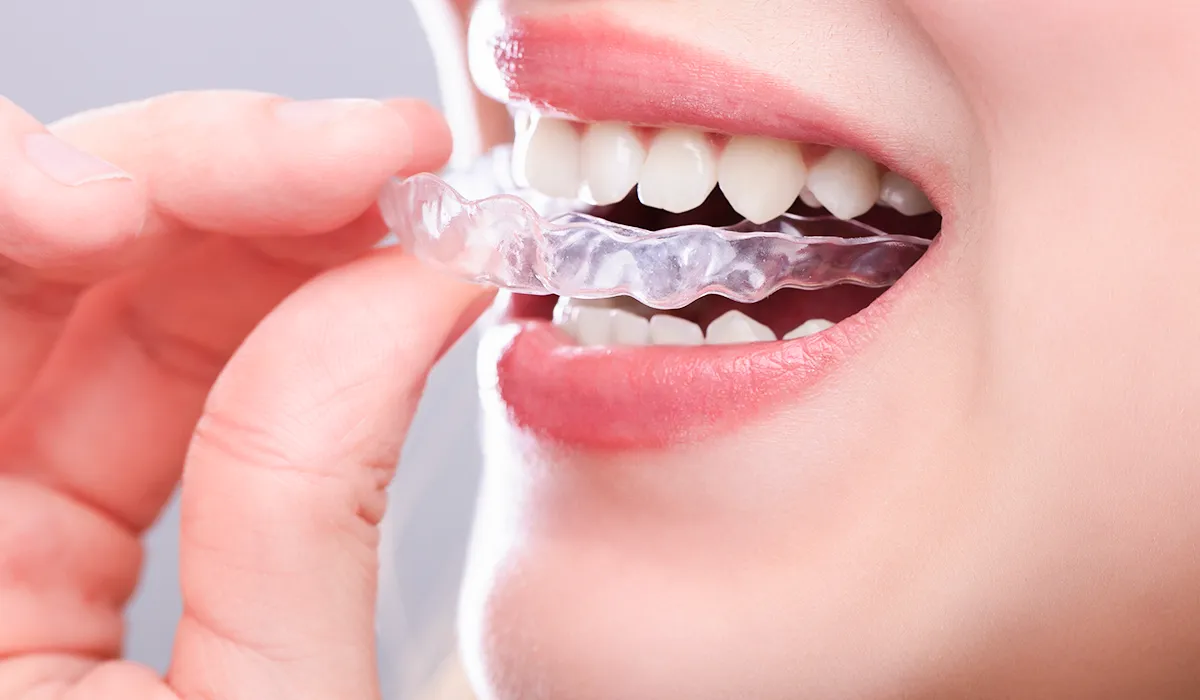 clear aligners
