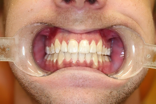 Severe Crowding Treated with Invisalign