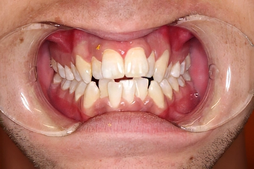 Severe Crowding Treated with Invisalign