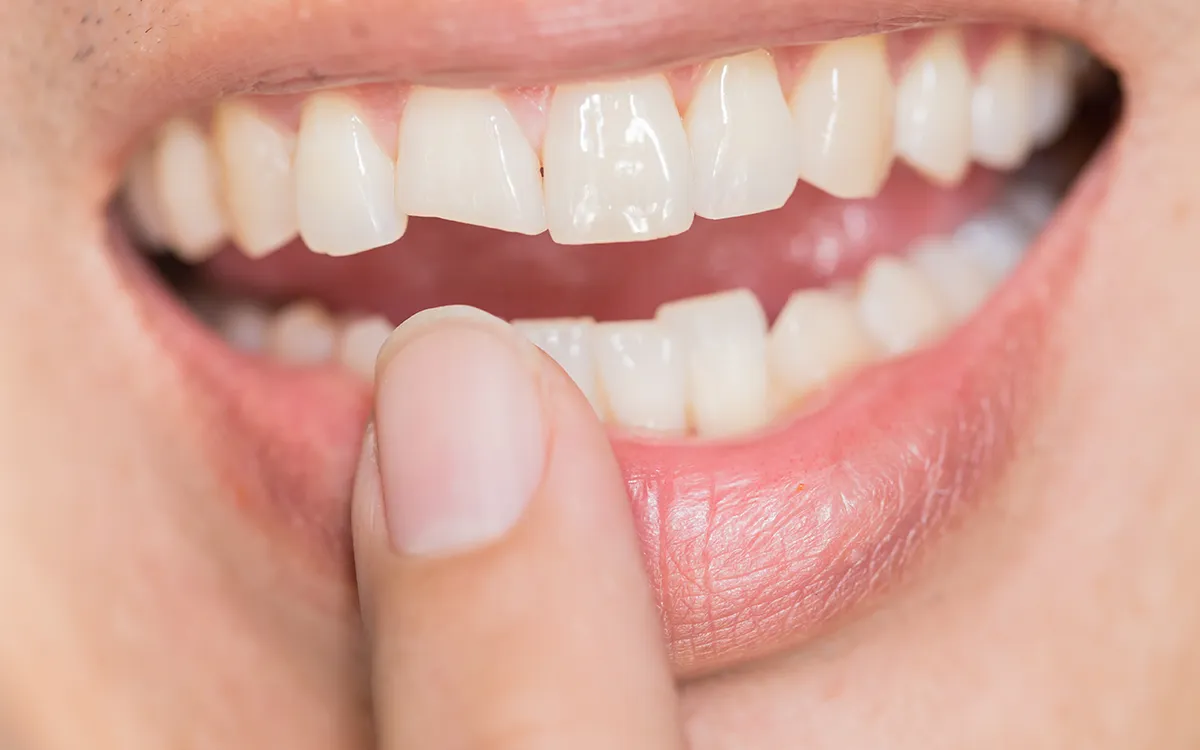 fractured tooth